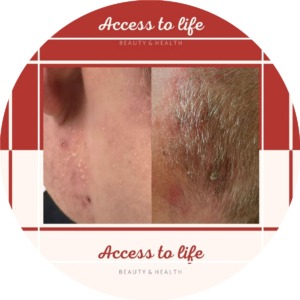Access to life | Dermatitis Cream | Eczeem | Rode Huid | Schilfers | Psoriasis