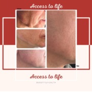 Voor en Na Huidverstrakking Access to life