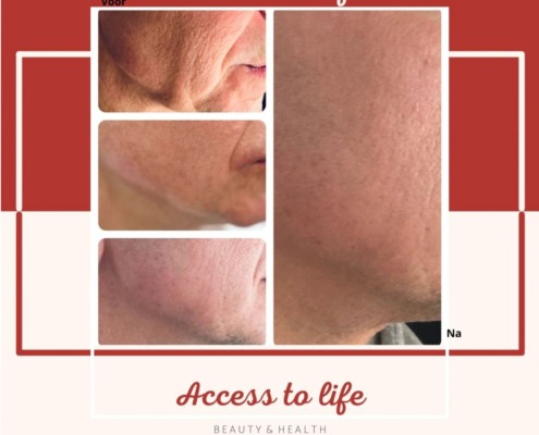 Voor en Na Huidverstrakking Access to life
