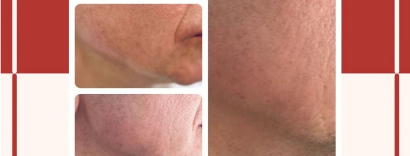 Voor en Na Huidverstrakking Access to life