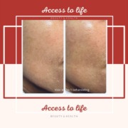 Voor en Na RF Behandeling Access to life