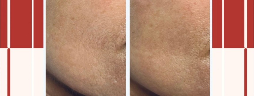 Voor en Na RF Behandeling Access to life